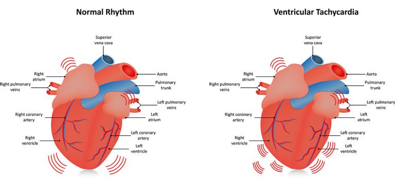 Ventricular Tachycardia - Heart and Vascular Wellness Center