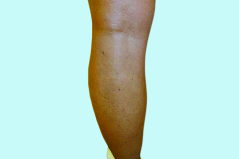 Venoase varice la nivelul picioarelor - simptome și metode de tratament